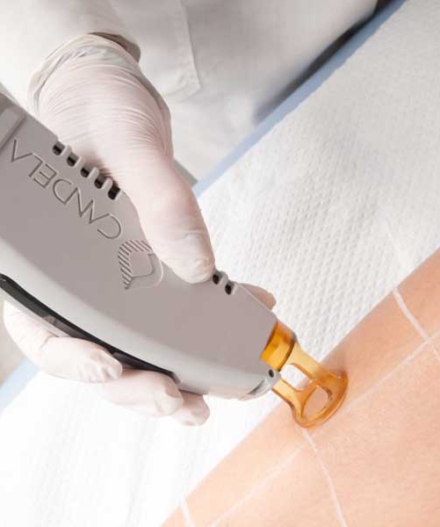 laser-apotrixosi-alexandrite-candela-athina